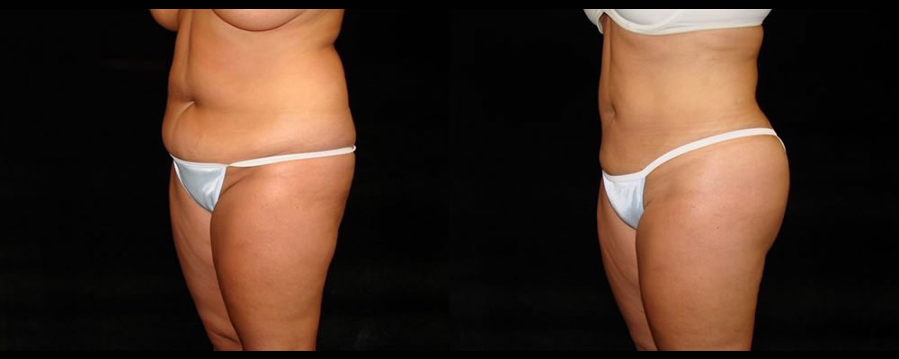 Liposuction Before & After Patient #343