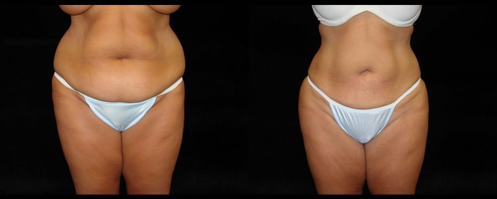 Liposuction Before & After Patient #343