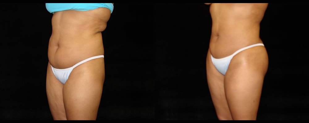 Liposuction Before & After Patient #339