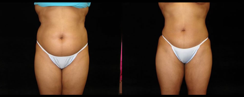 Liposuction Before & After Patient #339