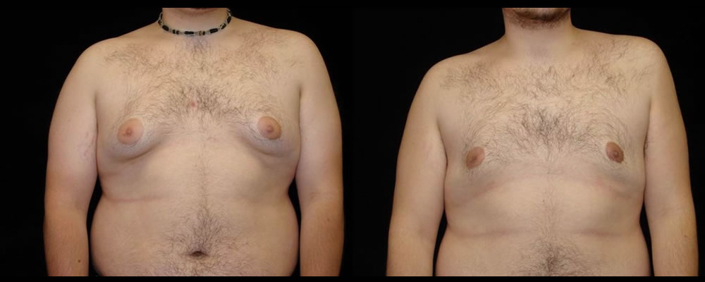 Liposuction Before & After Patient #335