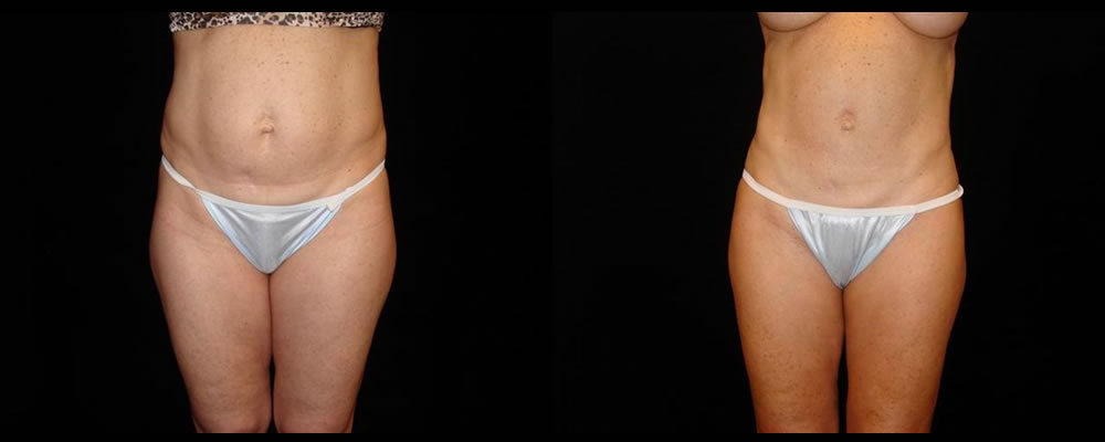 Liposuction Before & After Patient #402