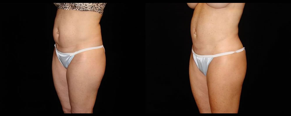Liposuction Before & After Patient #402