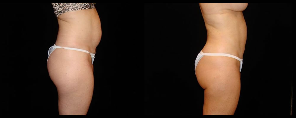 Liposuction Before & After Patient #402