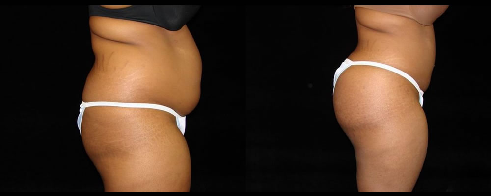 Liposuction Before & After Patient #331