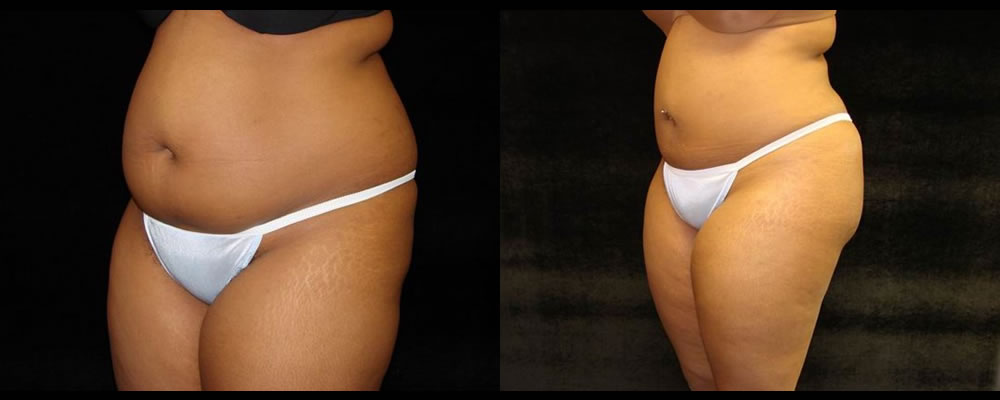 Liposuction Before & After Patient #331