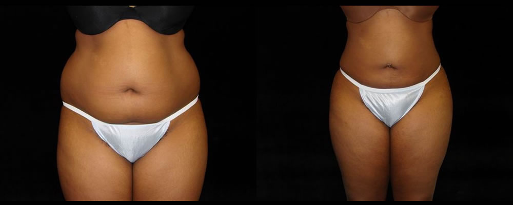 Liposuction Before & After Patient #331