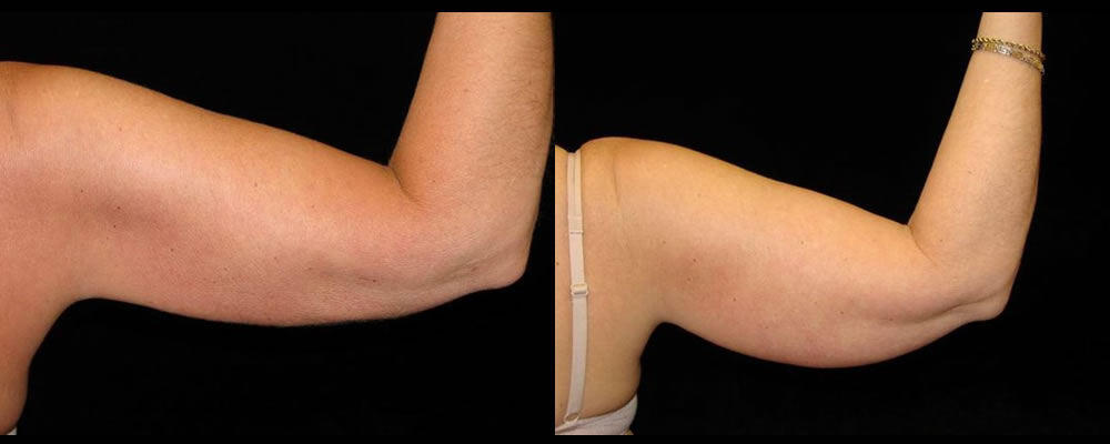 Liposuction Before & After Patient #327