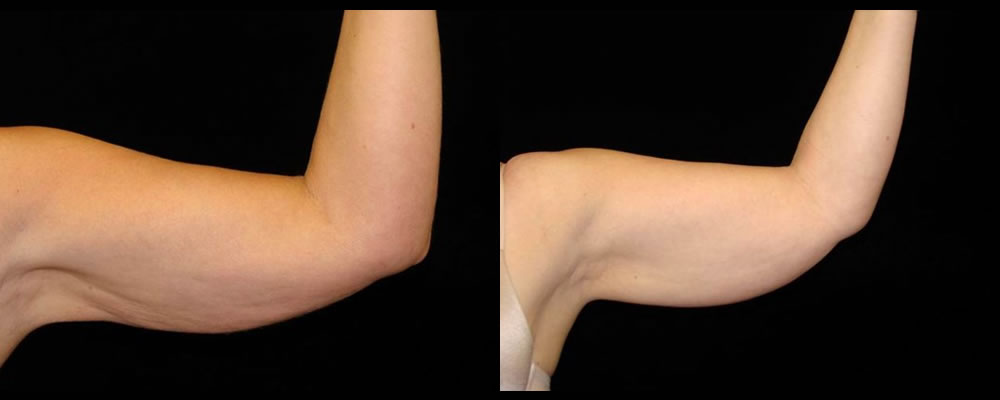 Liposuction Before & After Patient #327