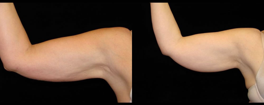 Liposuction Before & After Patient #327
