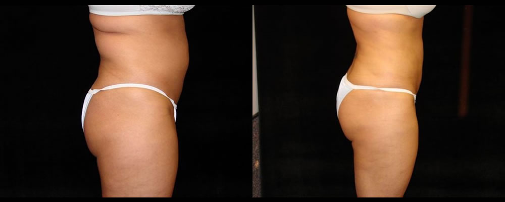 Liposuction Before & After Patient #323