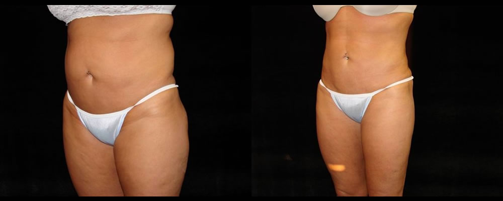 Liposuction Before & After Patient #323