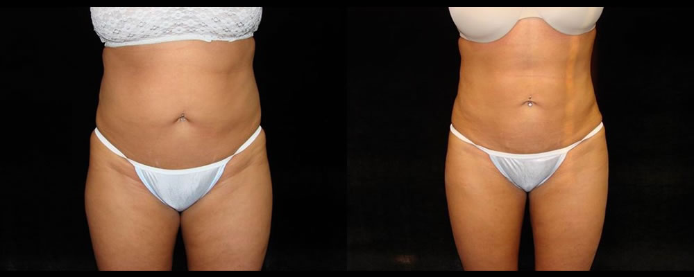 Liposuction Before & After Patient #323