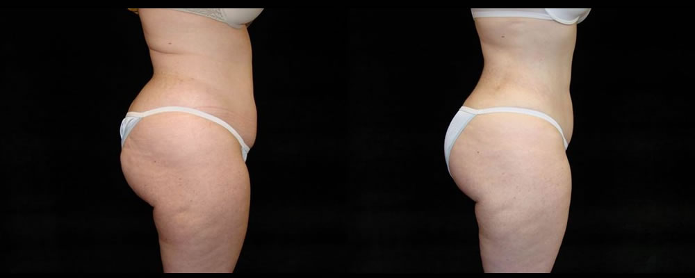 Liposuction Before & After Patient #321