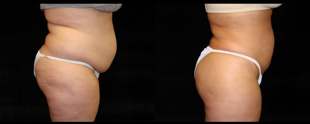 Liposuction Before & After Patient #317