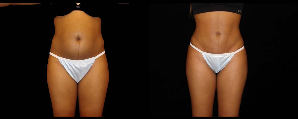 Liposuction Before & After Patient #398