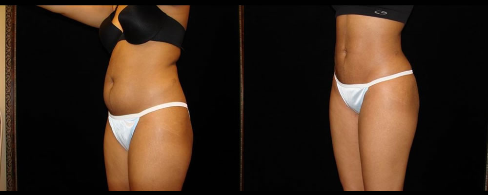 Liposuction Before & After Patient #398