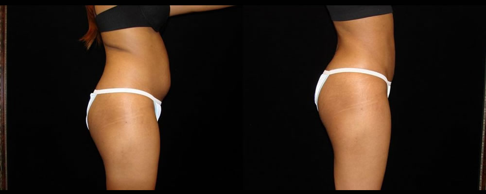 Liposuction Before & After Patient #398