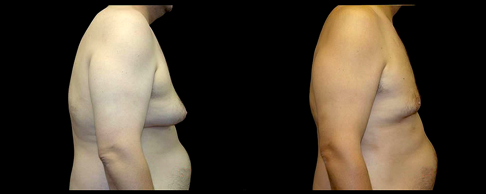 Liposuction Before & After Patient #394