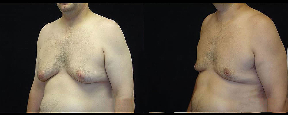 Liposuction Before & After Patient #394