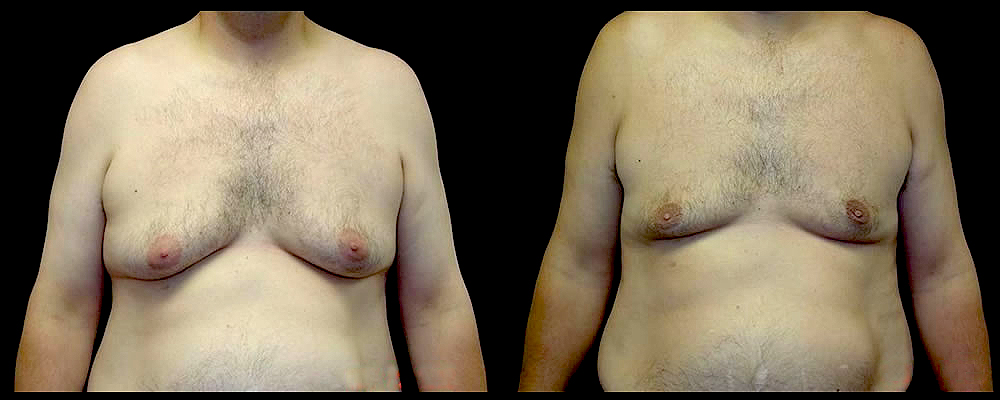 Liposuction Before & After Patient #394