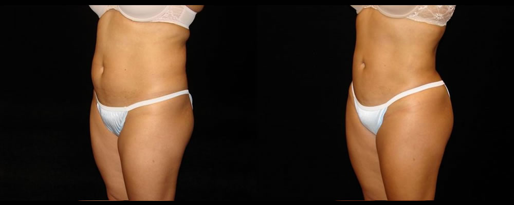 Liposuction Before & After Patient #390