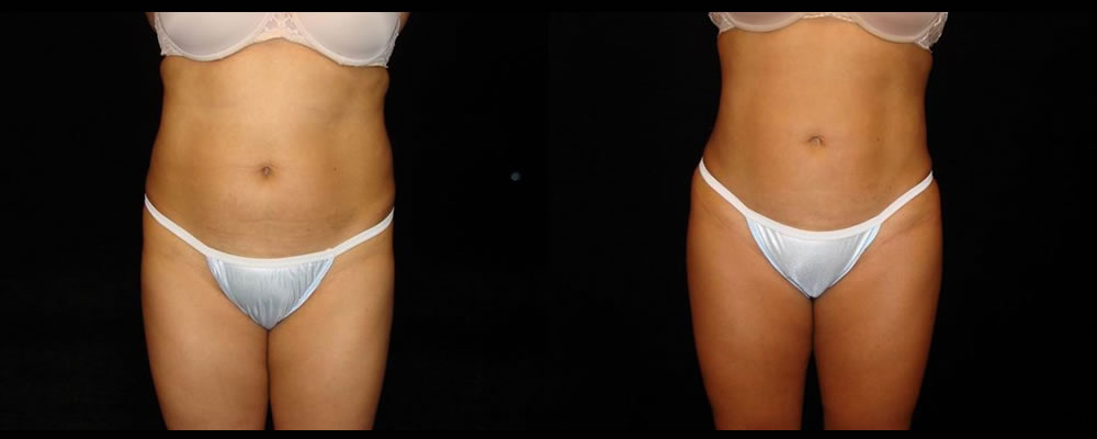 Liposuction Before & After Patient #390