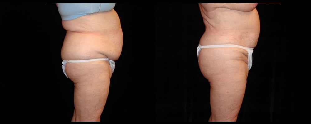 Liposuction Before & After Patient #386