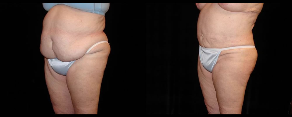 Liposuction Before & After Patient #386