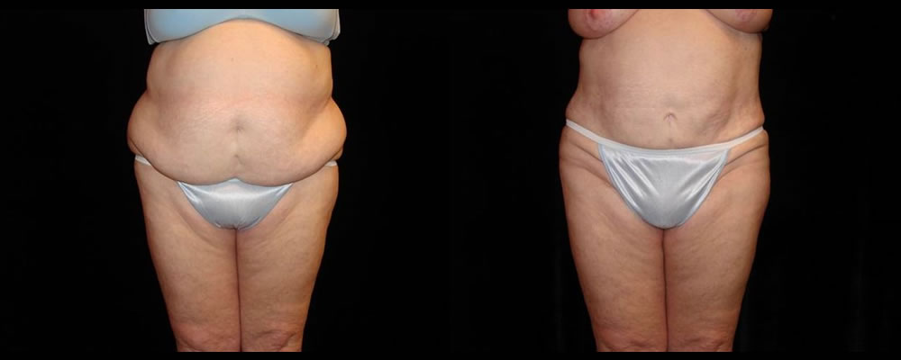 Liposuction Before & After Patient #386