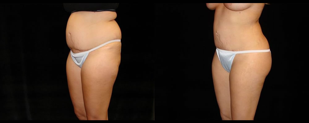 Liposuction Before & After Patient #382