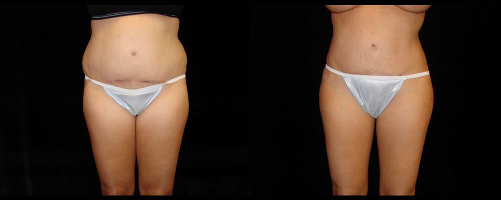 Liposuction Before & After Patient #382