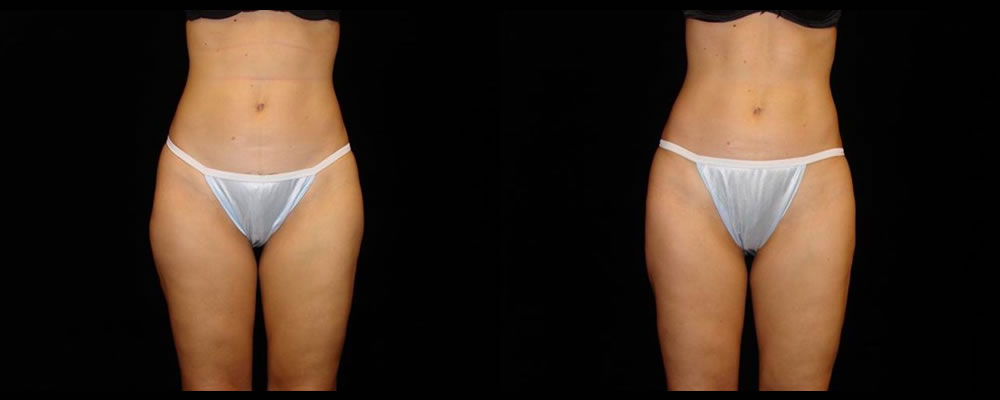 Liposuction Before & After Patient #379