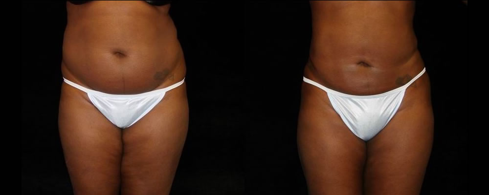 Liposuction Before & After Patient #375