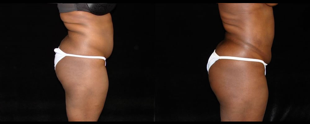 Liposuction Before & After Patient #375