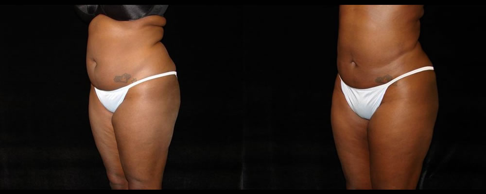 Liposuction Before & After Patient #375