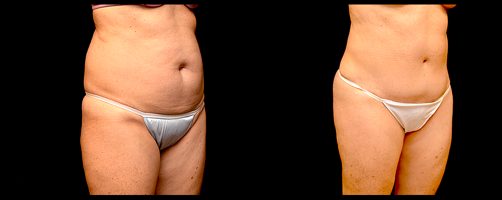 Liposuction Before & After Patient #311