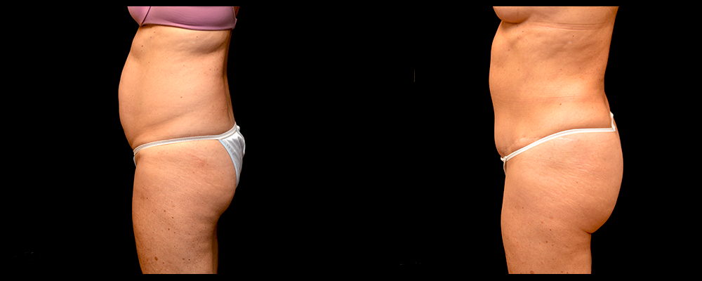 Liposuction Before & After Patient #311