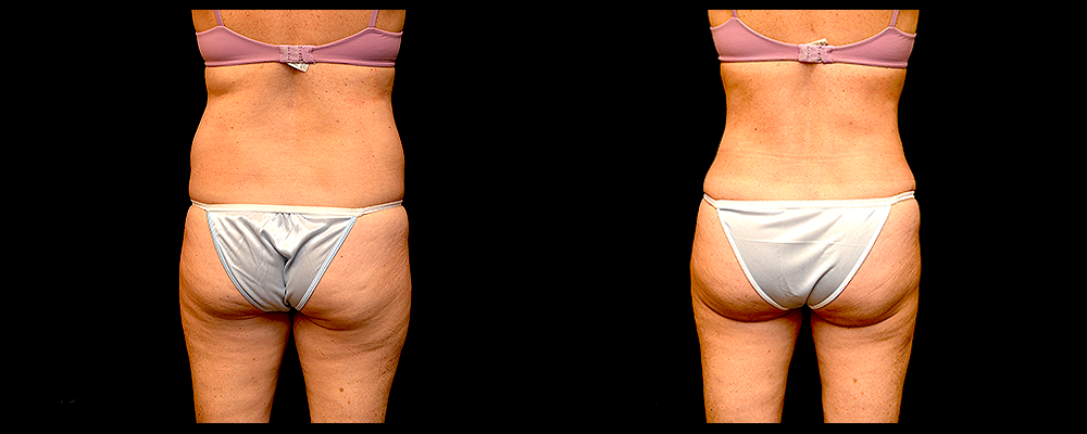 Liposuction Before & After Patient #311