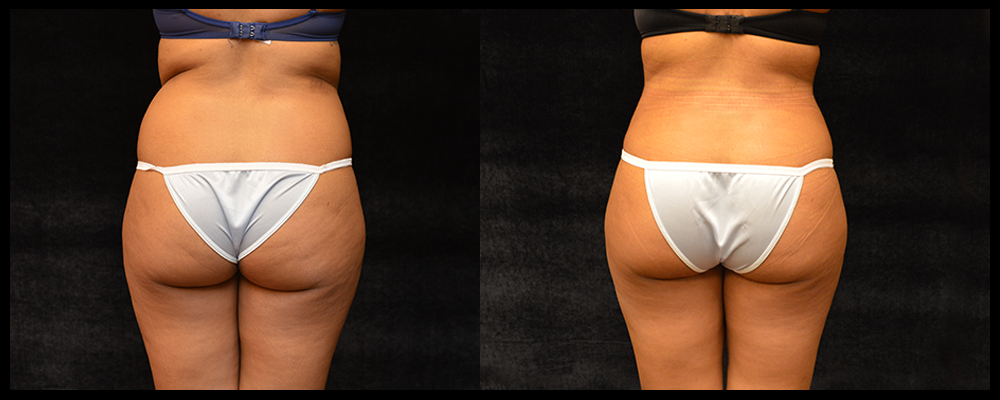 Liposuction Before & After Patient #307