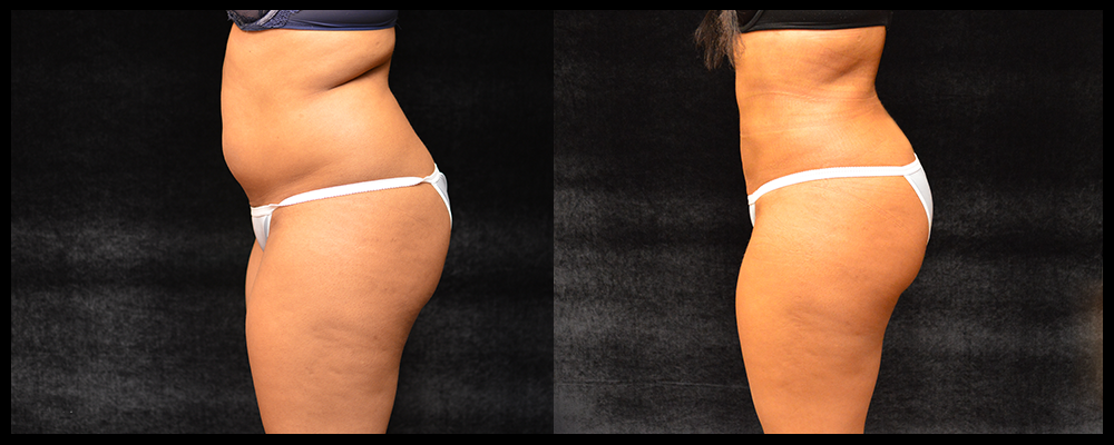 Liposuction Before & After Patient #307