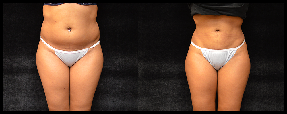 Liposuction Before & After Patient #307