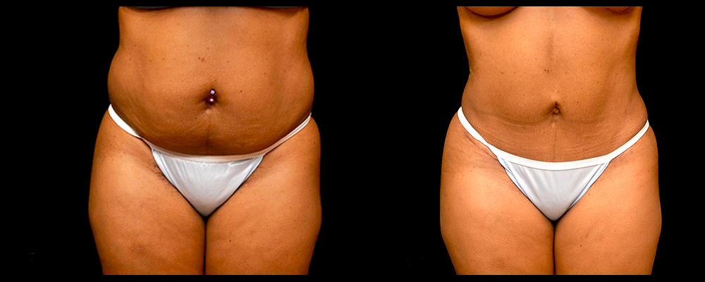 Liposuction Before & After Patient #303