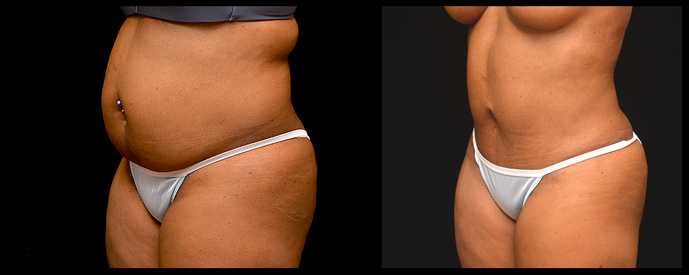 Liposuction Before & After Patient #303