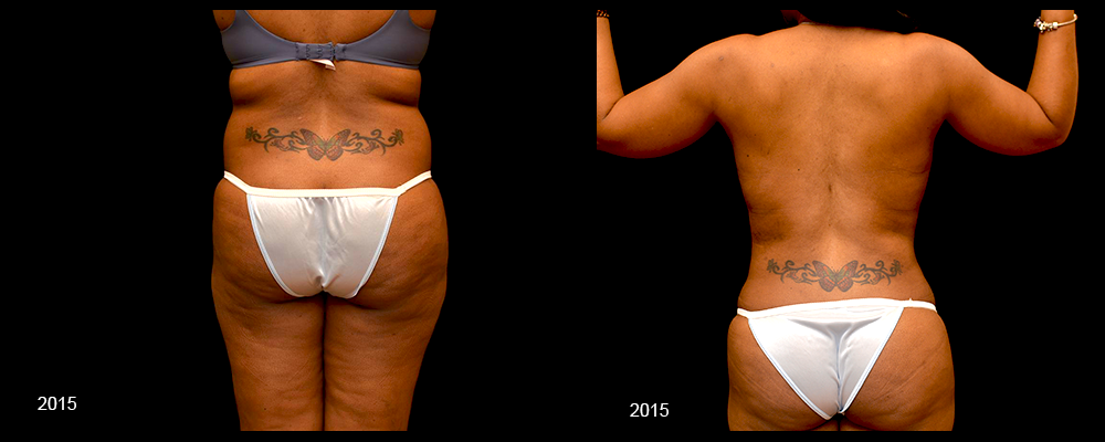 Liposuction Before & After Patient #303