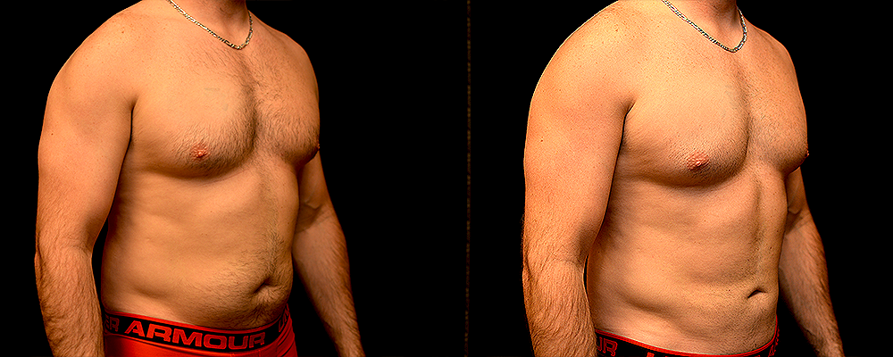 Liposuction Before & After Patient #299