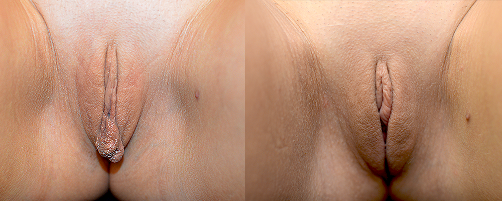 Labiaplasty Before & After Patient #282