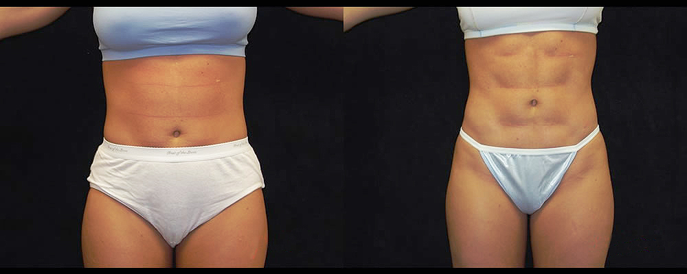 Six Pack Abs Before & After Patient #1149
