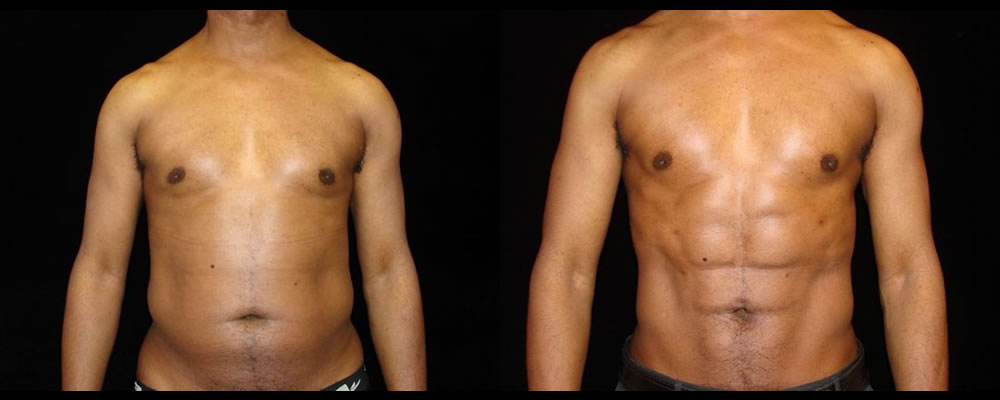 Six Pack Abs Before and After Photos Baltimore - Plastic Surgery Gallery  Columbia - Dr. Daniel Markmann