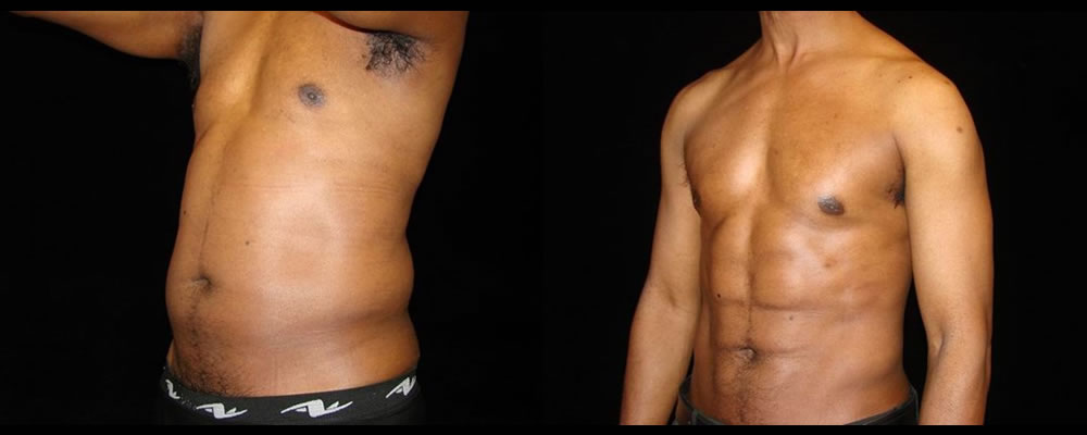 Six Pack Abs Before & After Patient #1145